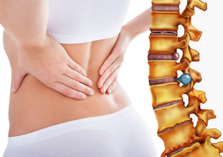 Cách chữa phồng Đĩa Đệm tại nhà, phương pháp hiệu quả và an toàn