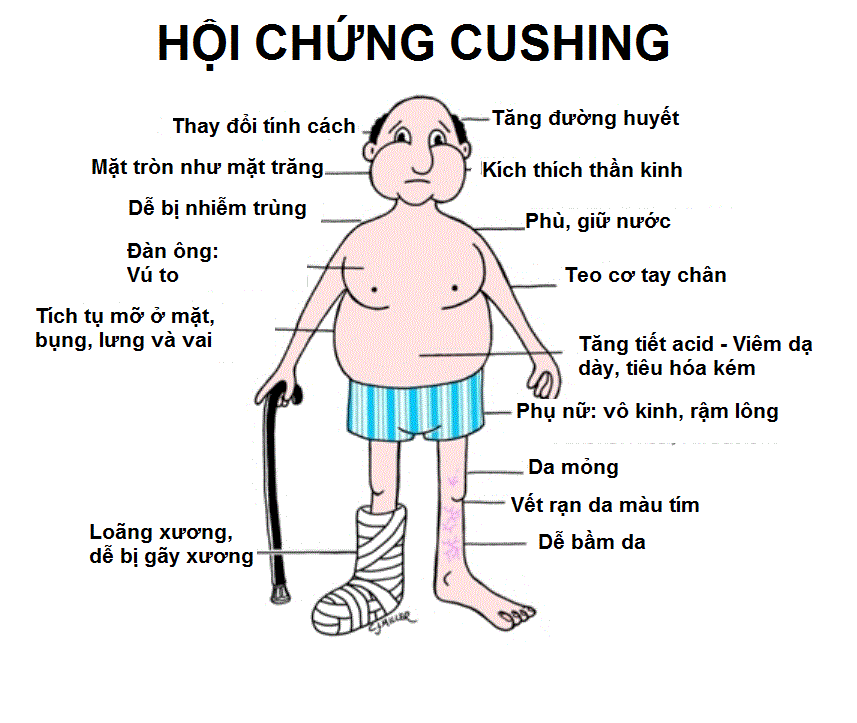 Hội chứng cushing - tổng quan và tầm quan trọng